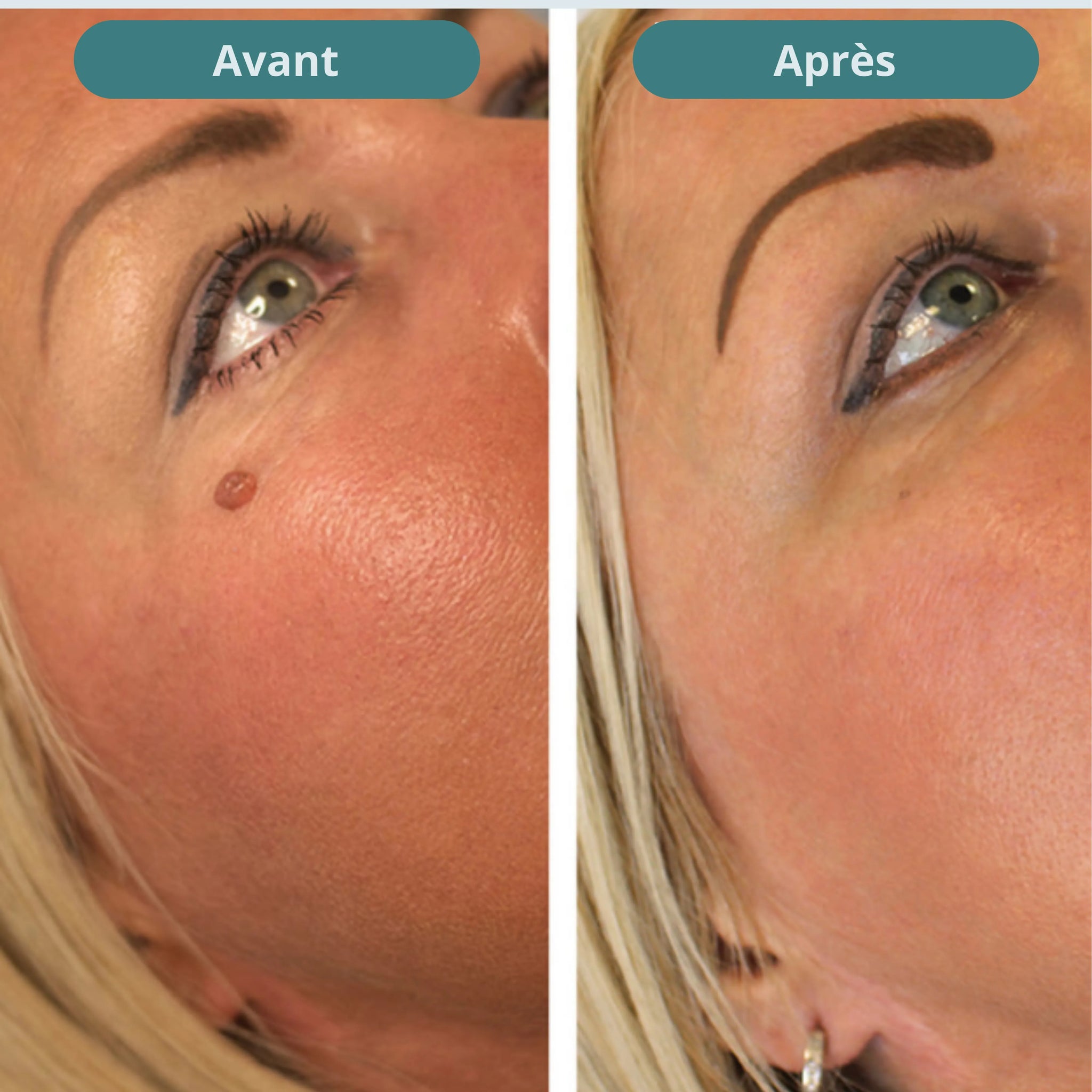Vitanesia™ Pro Acrochordons Patch Cutané + Aloe Vera