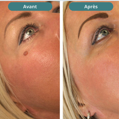 Vitanesia™ Pro Acrochordons Patch Cutané + Aloe Vera