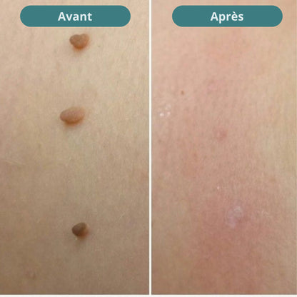 Vitanesia™ Pro Acrochordons Patch Cutané + Aloe Vera