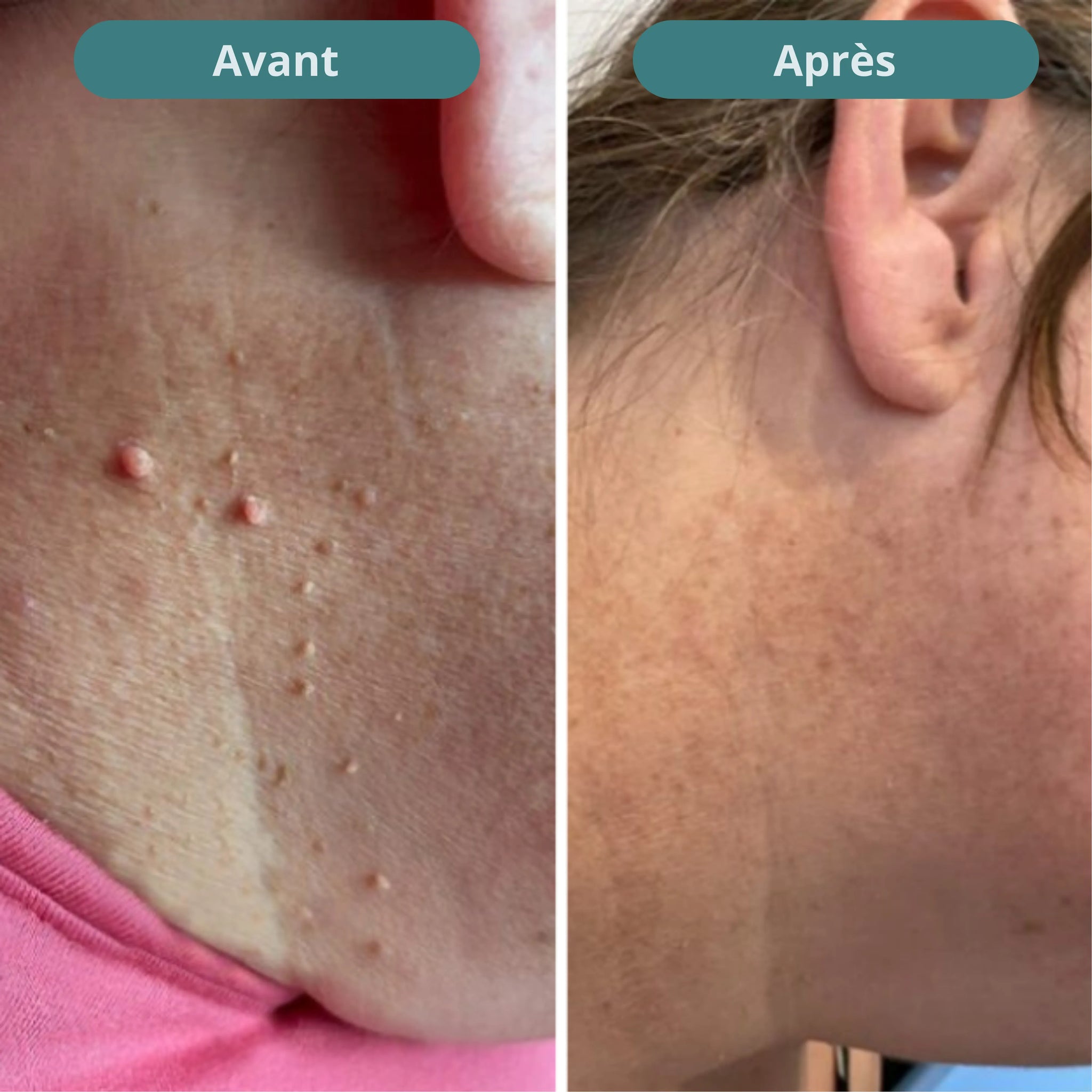 Vitanesia™ Pro Acrochordons Patch Cutané + Aloe Vera