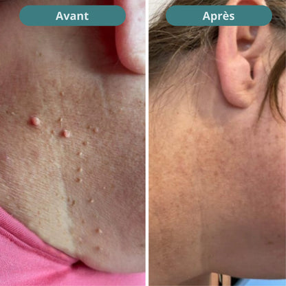 Vitanesia™ Pro Acrochordons Patch Cutané + Aloe Vera