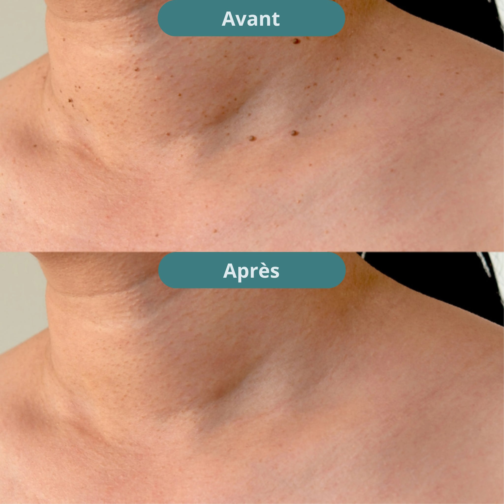 Vitanesia™ Pro Acrochordons Patch Cutané + Aloe Vera