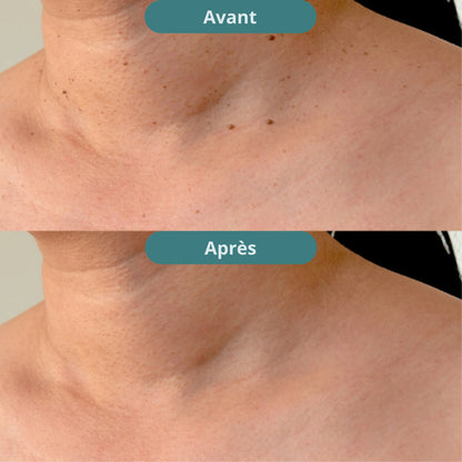 Vitanesia™ Pro Acrochordons Patch Cutané + Aloe Vera