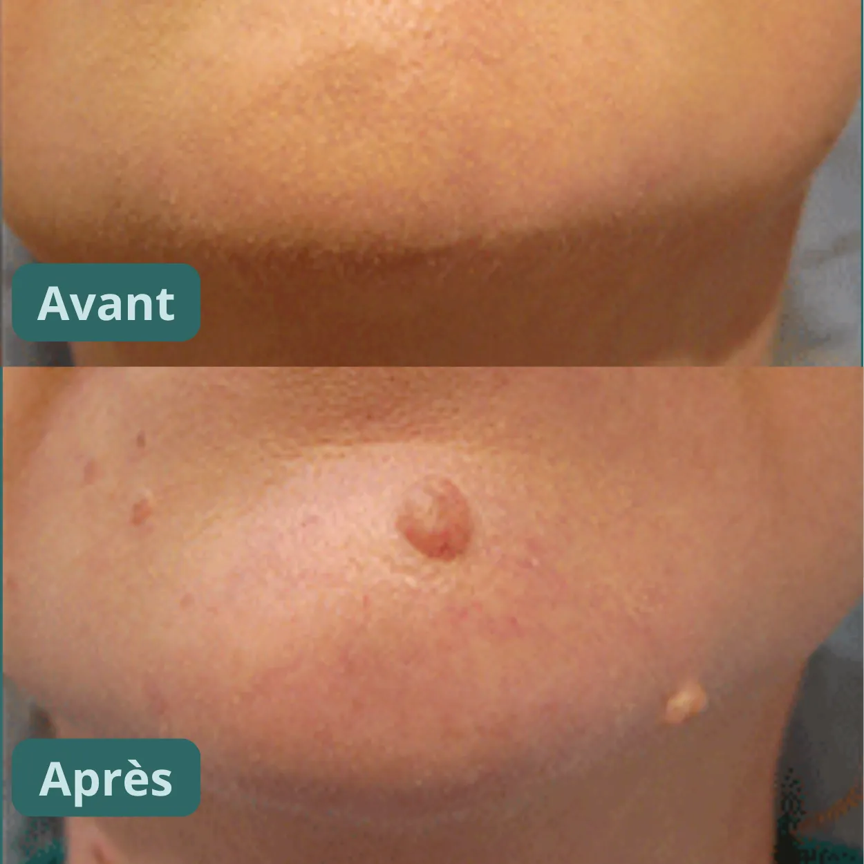 Vitanesia™ Pro Acrochordons Patch Cutané + Aloe Vera